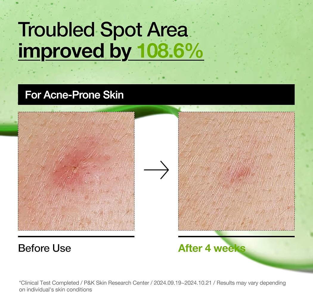 Anua 10+ AZELAIC ACID 10 + HYALURON REDNESS SOOTHING SERUM ANUA SERUM APAISANT ROUGEURS AZELAIC ACIDE 10 HYALURONIQUE 30 ML 1.01 FL. OZ